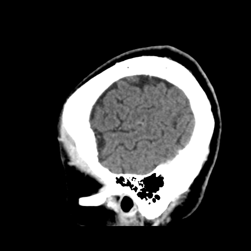 Atypical meningioma (WHO grade II) with osseous invasion (Radiopaedia 53654-59715 G 47).png