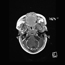 Atypical teratoid rhabdoid tumor (prenatal US and neonatal MRI) (Radiopaedia 59091-66388 Axial T1 C+ 11).jpg