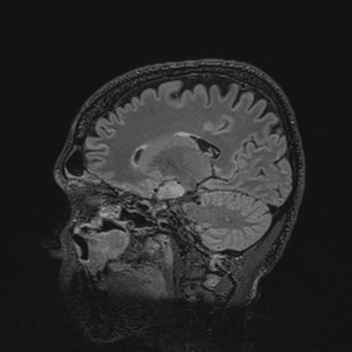 Autoimmune limbic encephalitis (Radiopaedia 30363-31005 Sagittal FLAIR 96).jpg