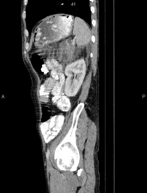 Autoimmune pancreatitis (Radiopaedia 84925-100431 E 75).jpg