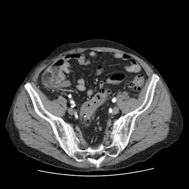 Autosomal dominant polycystic kidney disease (Radiopaedia 27851-28094 B 101).jpg
