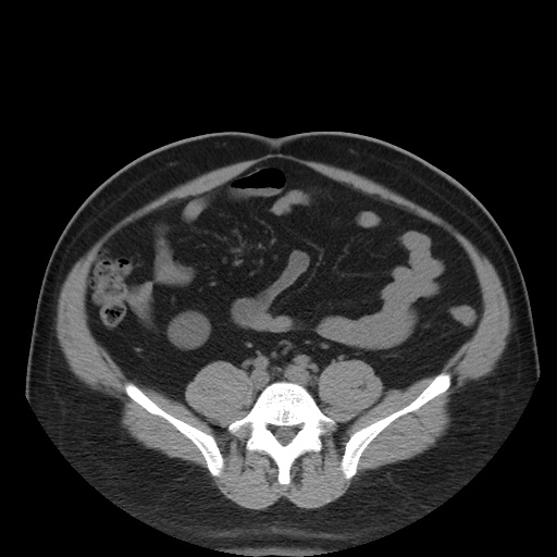 Autosomal dominant polycystic kidney disease (Radiopaedia 50259-55612 Axial non-contrast 58).jpg
