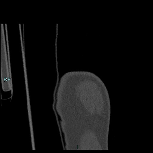 Avascular necrosis after fracture dislocations of the proximal humerus (Radiopaedia 88078-104655 Coronal bone window 15).jpg