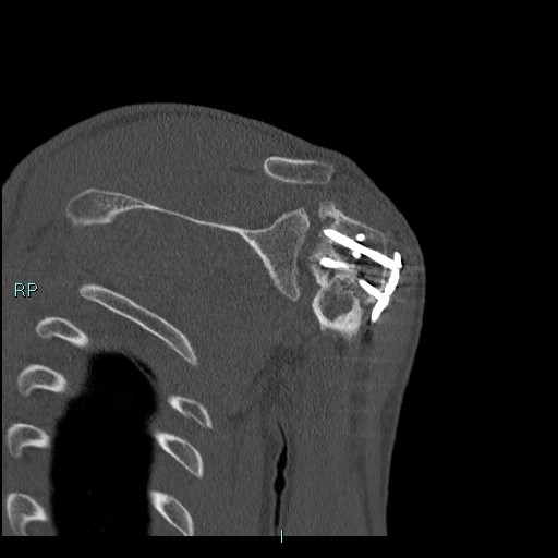 Avascular necrosis after fracture dislocations of the proximal humerus (Radiopaedia 88078-104655 Coronal bone window 85).jpg