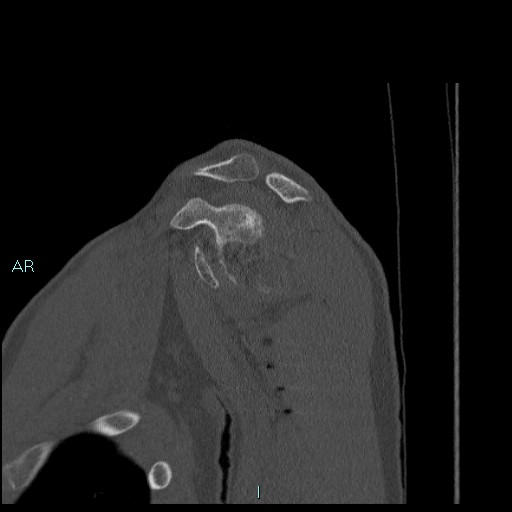 File:Avascular necrosis after fracture dislocations of the proximal humerus (Radiopaedia 88078-104655 Sagittal bone window 29).jpg
