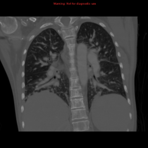 Avascular necrosis in sickle cell disease (Radiopaedia 17448-17152 Coronal bone window 83).jpg