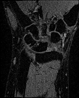 Avascular necrosis of the capitate (Radiopaedia 88317-104948 Coronal T1 vibe 48).jpg