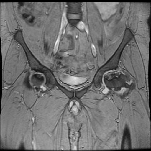 Avascular necrosis of the hip (Radiopaedia 61503-69465 F 31).jpg