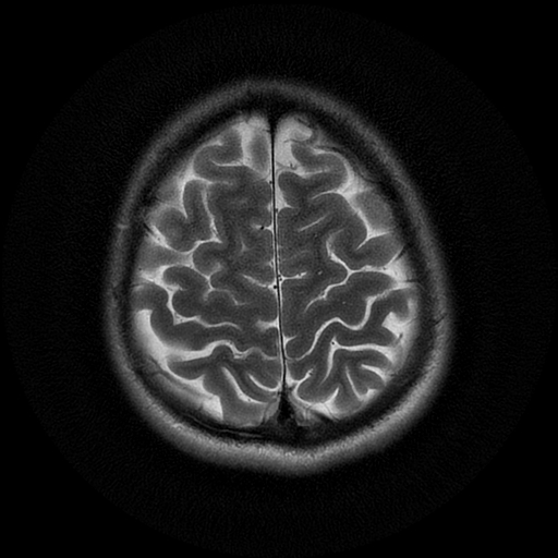 File:Azygos anterior cerebral artery (Radiopaedia 17059-16756 Axial T2 4).jpg