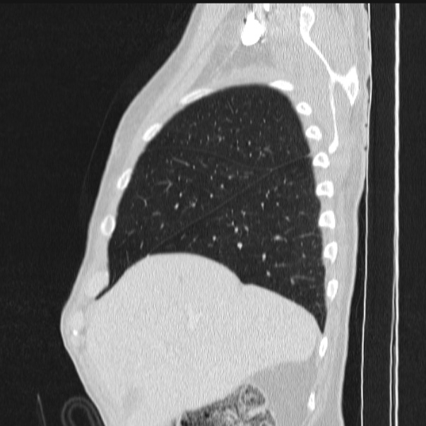 Azygos lobe (Radiopaedia 38259-40275 lung window 20).jpg