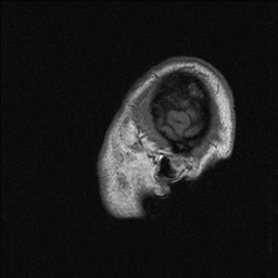Balo concentric sclerosis (Radiopaedia 50458-55940 Sagittal T1 145).jpg