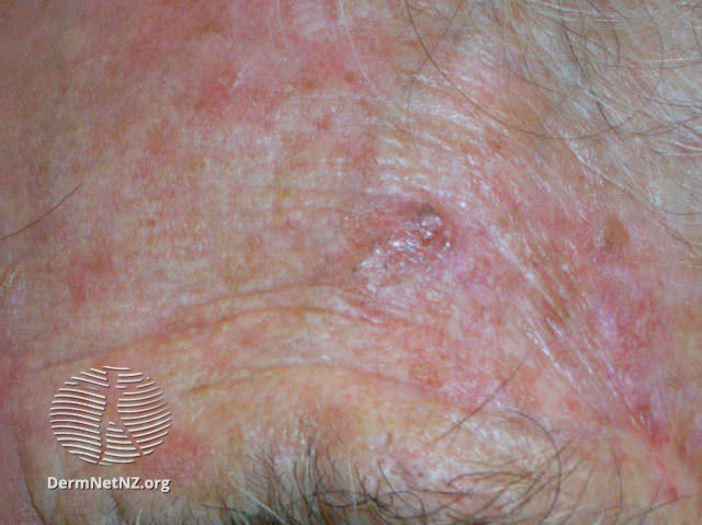 Basal cell carcinoma affecting the face (DermNet NZ lesions-bcc-face-0770).jpg
