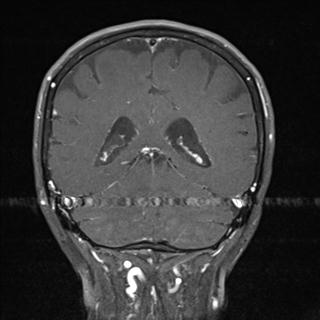 File:Base of skull chondrosarcoma (Radiopaedia 30410-31070 G 20).jpg