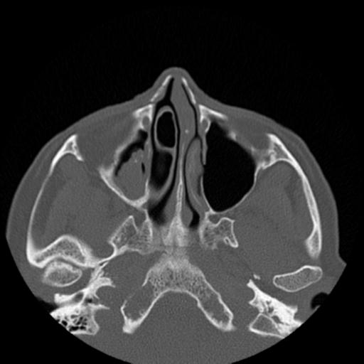 File:Base of skull chondrosarcoma (Radiopaedia 30410-31071 Axial bone window 18).jpg