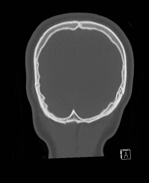 Base of skull fracture with bilateral Le Fort fractures (Radiopaedia 47094-51638 Coronal bone window 13).jpg