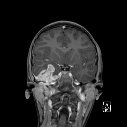 Base of skull rhabdomyosarcoma (Radiopaedia 32196-33142 I 35).jpg