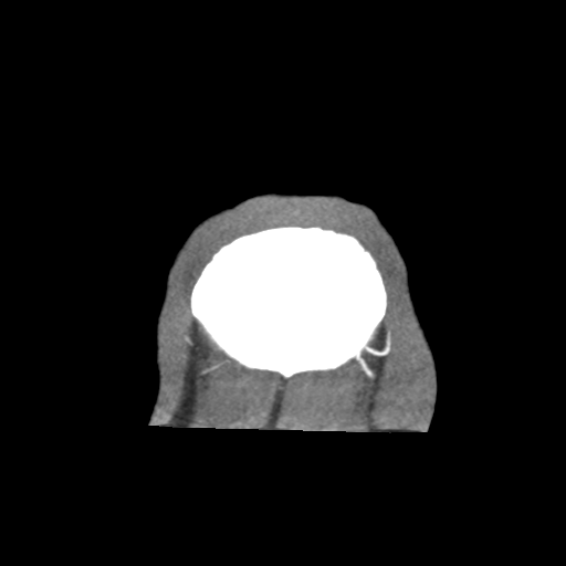 Basilar and bilateral vertebral artery occlusion (Radiopaedia 45592-49723 B 99).png