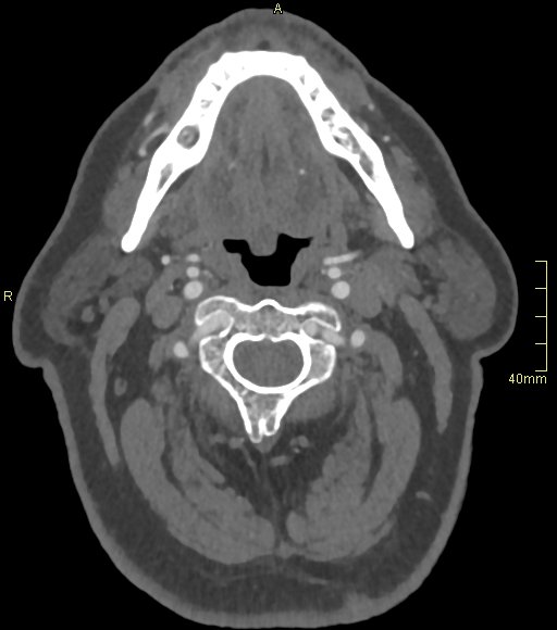 Basilar artery aneurysm (Radiopaedia 56261-62932 A 14).jpg