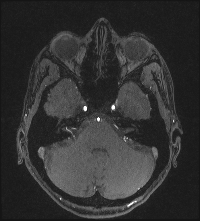 Basilar artery perforator aneurysm (Radiopaedia 82455-97733 Axial MRA 68).jpg