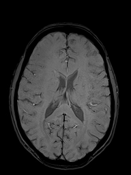 Basilar artery perforator aneurysm (Radiopaedia 82455-97733 Axial SWI 35).jpg