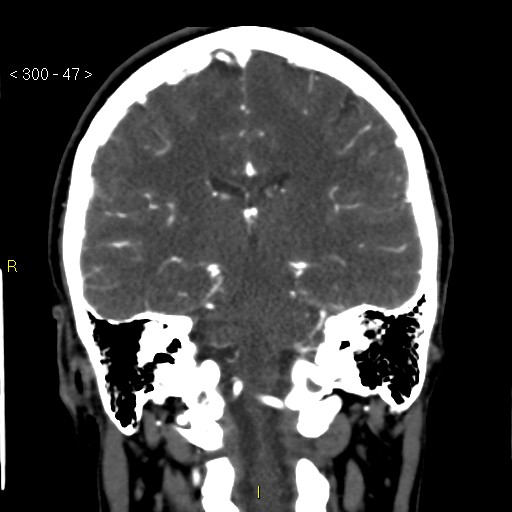 File:Basilar artery thrombosis (Radiopaedia 16260-15944 B 38).jpg