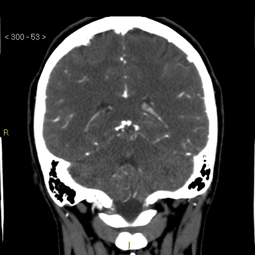 File:Basilar artery thrombosis (Radiopaedia 16260-15944 B 44).jpg