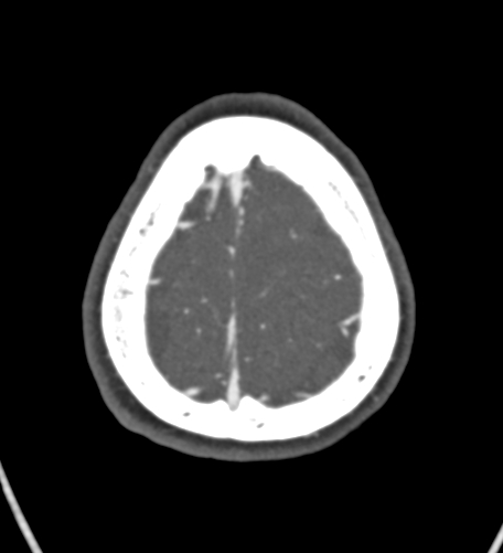 File:Basilar tip aneurysm with coiling (Radiopaedia 53912-60086 A 134).jpg
