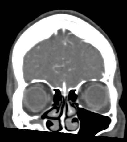 Basilar tip aneurysm with coiling (Radiopaedia 53912-60086 B 19).jpg