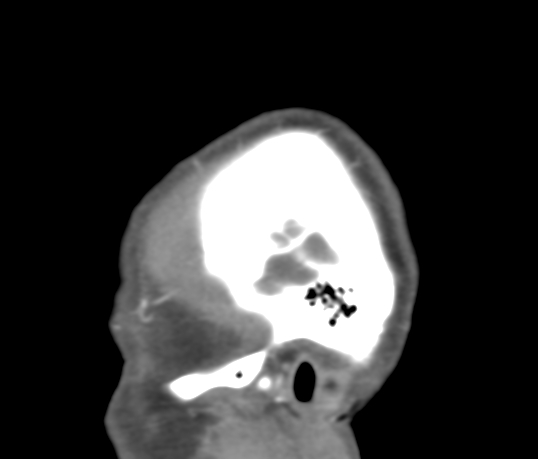 Basilar tip aneurysm with coiling (Radiopaedia 53912-60086 C 2).jpg