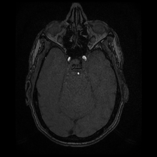 Basilar top and left middle cerebral artery aneurysm (Radiopaedia 61965-70031 Axial MRA 50).jpg