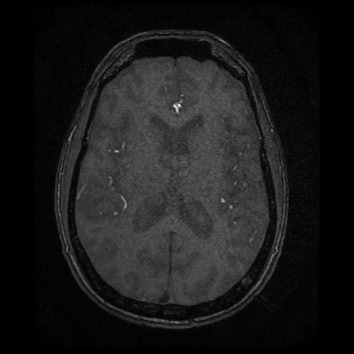 Basilar top and left middle cerebral artery aneurysm (Radiopaedia 61965-70031 Axial MRA 97).jpg