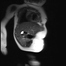 File:Beckwith-Wiedeman syndrome with bilateral Wilms tumors (Radiopaedia 60850-69233 B 24).jpg