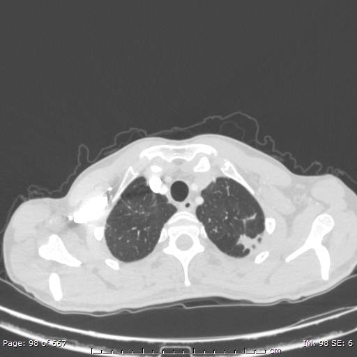 File:Behçet disease (Radiopaedia 44247-47889 Axial lung window 7).jpg