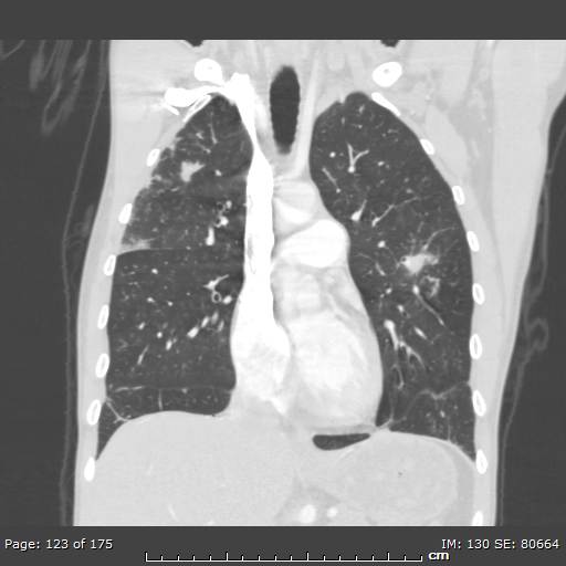 Behçet disease (Radiopaedia 44247-47889 Coronal lung window 38).jpg