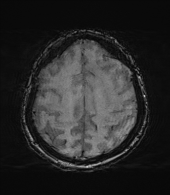 File:Behavioral variant frontotemporal dementia and late onset schizophrenia (Radiopaedia 52197-58083 Axial SWI 58).png