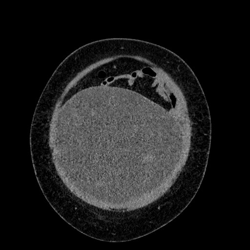 File:Benign leiomyoma with hydropic features (Radiopaedia 89250-106130 B 22).jpg