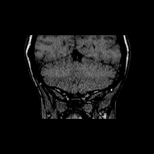 File:Berry aneurysm of the terminal internal carotid artery (Radiopaedia 88286-104918 Coronal TOF 98).jpg