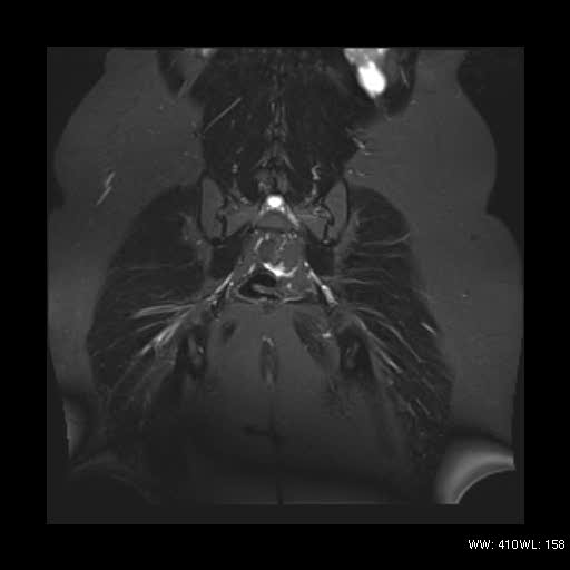 File:Bicornuate uterus- on MRI (Radiopaedia 49206-54297 Coronal STIR 17).jpg