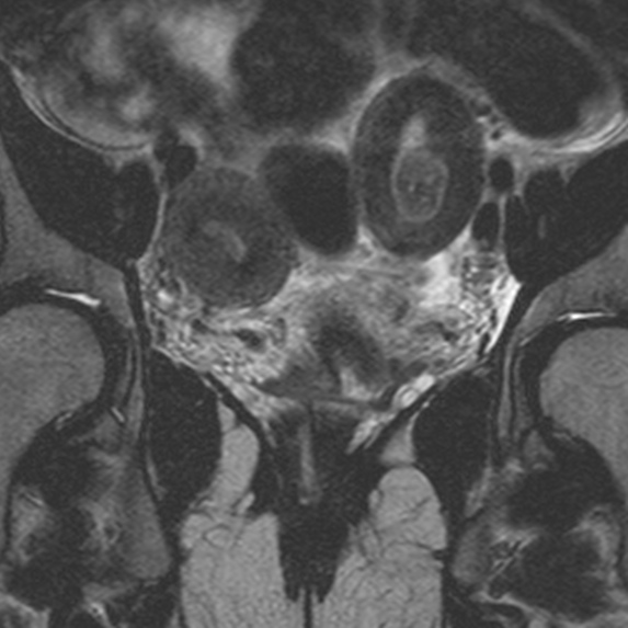 File:Bicornuate uterus (Radiopaedia 24677-24949 Coronal T2 5).jpg