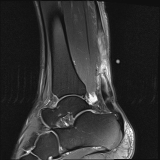 File:Bilateral Achilles tendon complete tear (Radiopaedia 81344-95051 Sagittal T2 fat sat 23).jpg