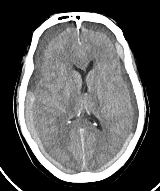 Bilateral acute on chronic subdural hematomas (Radiopaedia 78466-91146 Axial non-contrast 31).jpg