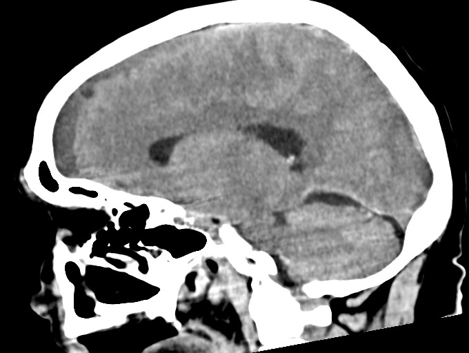 Bilateral acute on chronic subdural hematomas (Radiopaedia 78466-91146 C 26).jpg