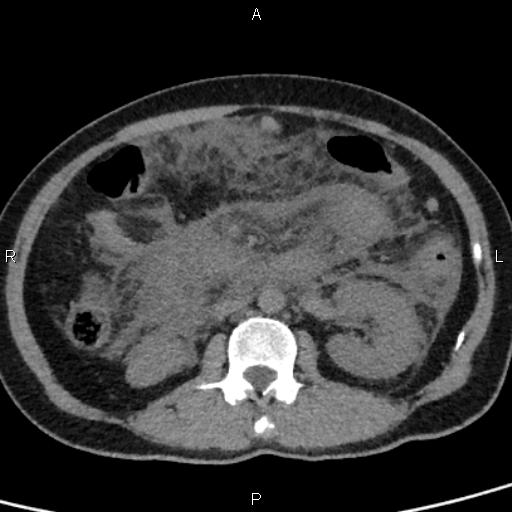 Bilateral adrenal gland hyperenhancement in pancreatitis (Radiopaedia 86642-102753 Axial non-contrast 53).jpg