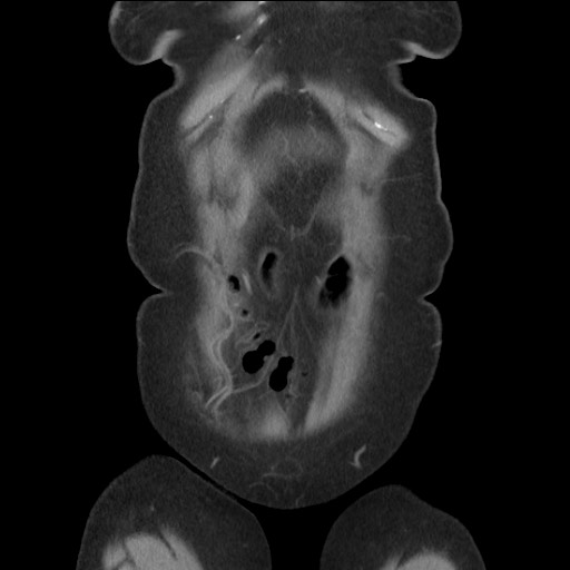 Bilateral adrenal granulocytic sarcomas (chloromas) (Radiopaedia 78375-91007 B 18).jpg