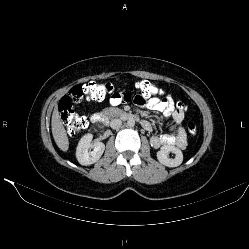 File:Bilateral adrenal myelolipoma (Radiopaedia 63058-71535 Axial C+ delayed 55).jpg