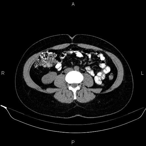 Bilateral adrenal myelolipoma (Radiopaedia 63058-71535 Axial non-contrast 101).jpg