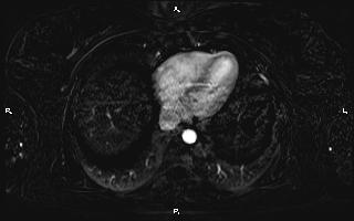 Bilateral adrenal myelolipoma (Radiopaedia 63058-71537 I 11).jpg
