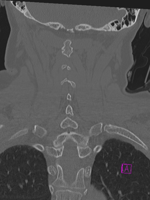 Bilateral atlanto-occipital assimilation (Radiopaedia 28350-28603 Coronal bone window 34).jpg