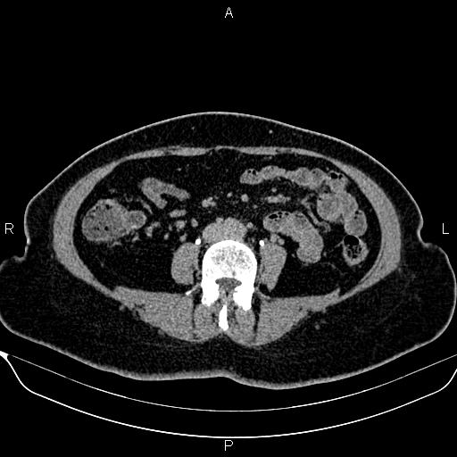 Bilateral benign adrenal adenomas (Radiopaedia 86912-103124 Axial C+ delayed 91).jpg