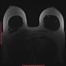 File:Bilateral breast implant rupture (Radiopaedia 24761-25027 PASTA 12).jpg
